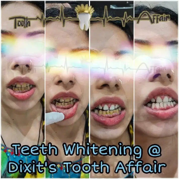 Before and after